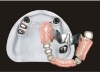 dental telesopic crown